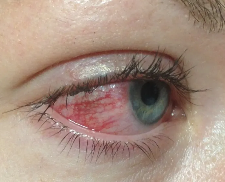 Trockene-Augen_1 Augenvorsorge-Checkup