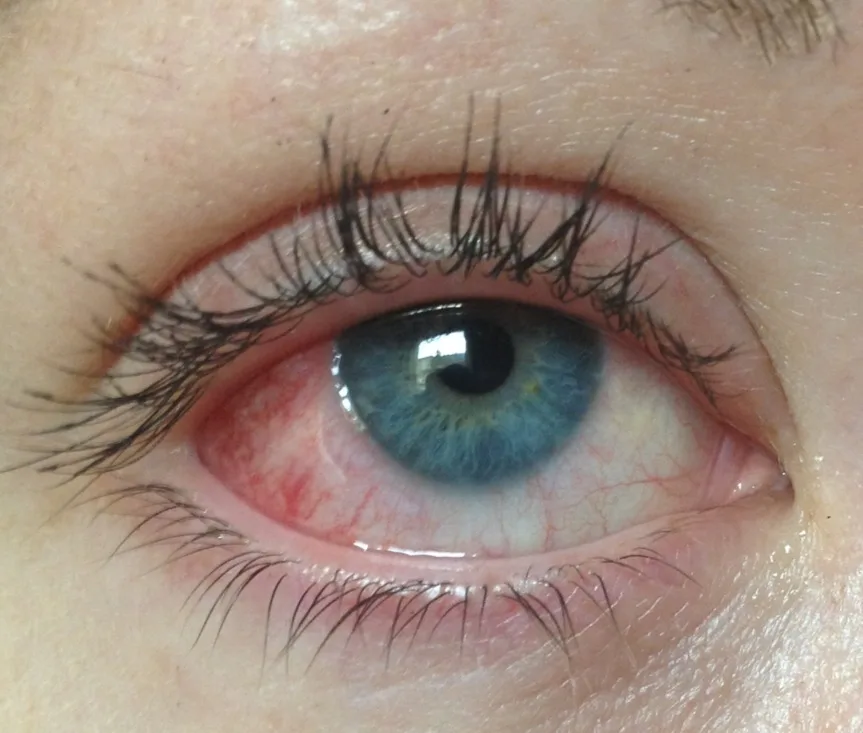 Trockene-Augen_2 Augenvorsorge-Checkup